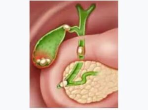 Complications of Gallbladder Stones
