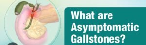 Asymptomatic Gallbladder Stone Treatment 
