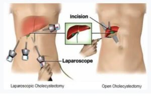 Best Gastro Surgeon Surgeon in Ahmedabad India