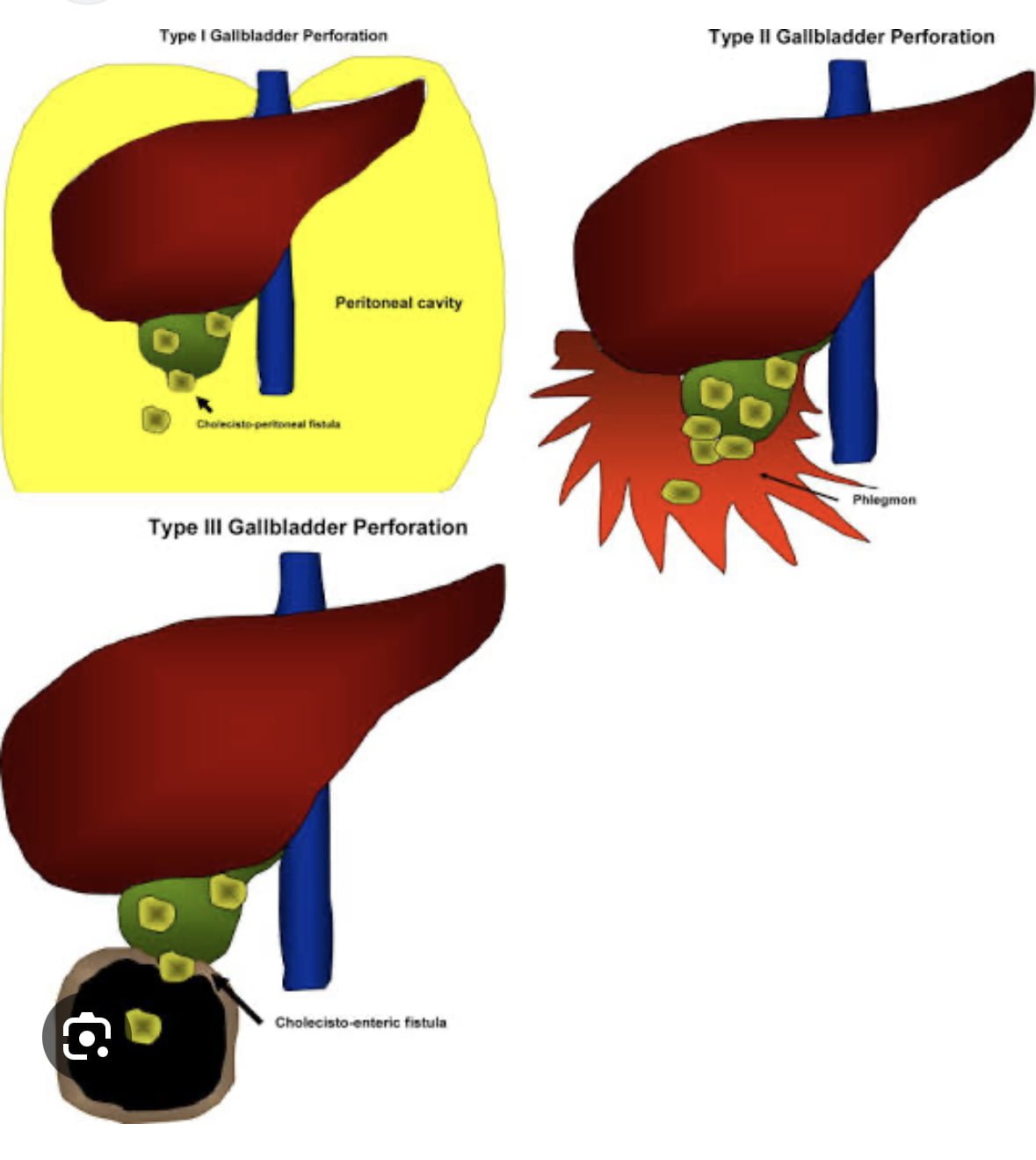 Gallbladder Perforation: Causes, Treatment, and Prevention