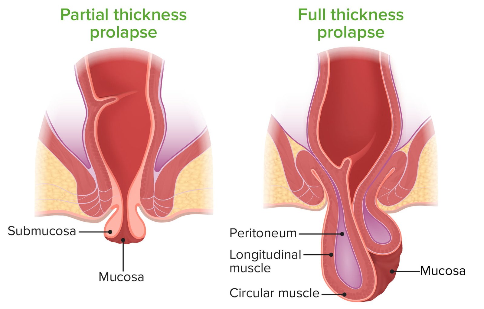 Rectal Prolapse and Constipation