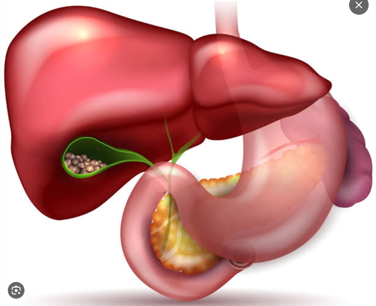 The Benefits of Early Gallbladder Removal for Gallstones