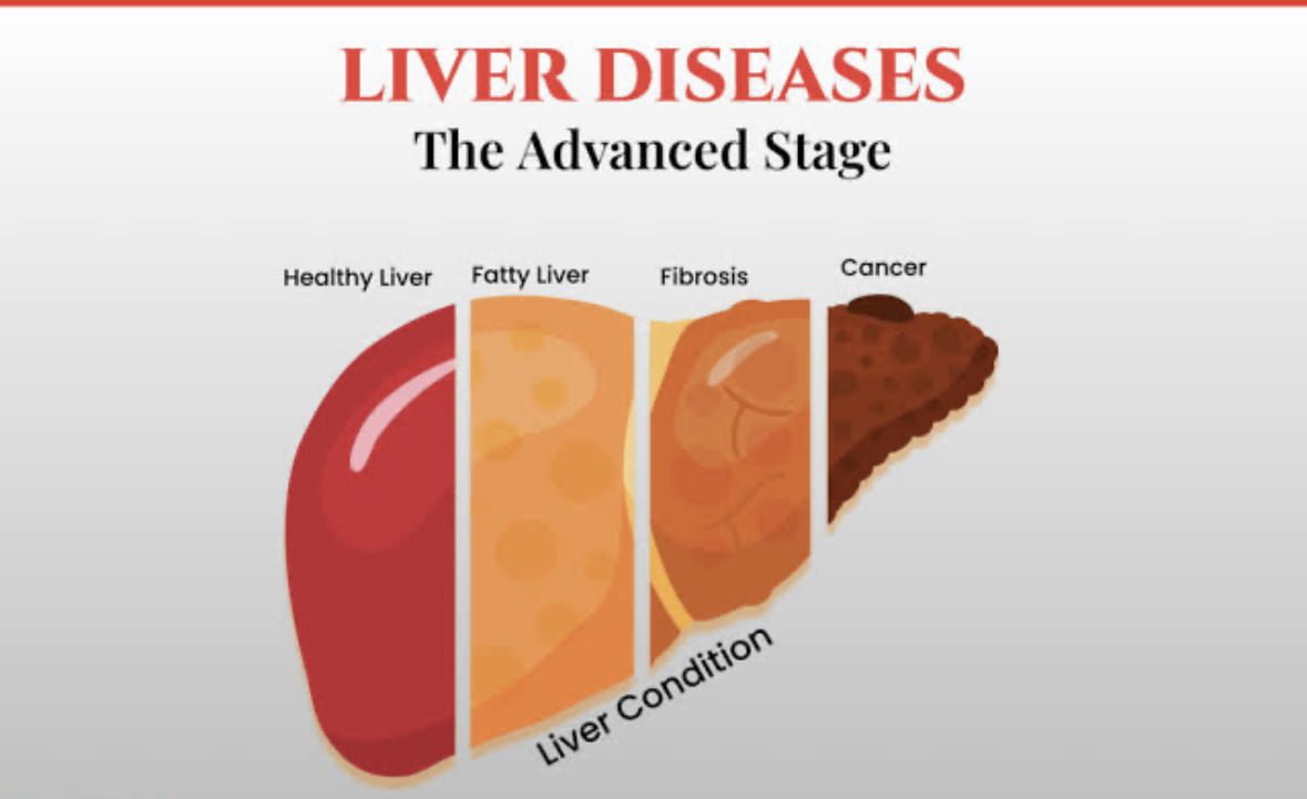 Revolutionary Advance in Fatty Liver Diagnosis: From Fuzzy Picture to Crystal-Clear Fingerprint