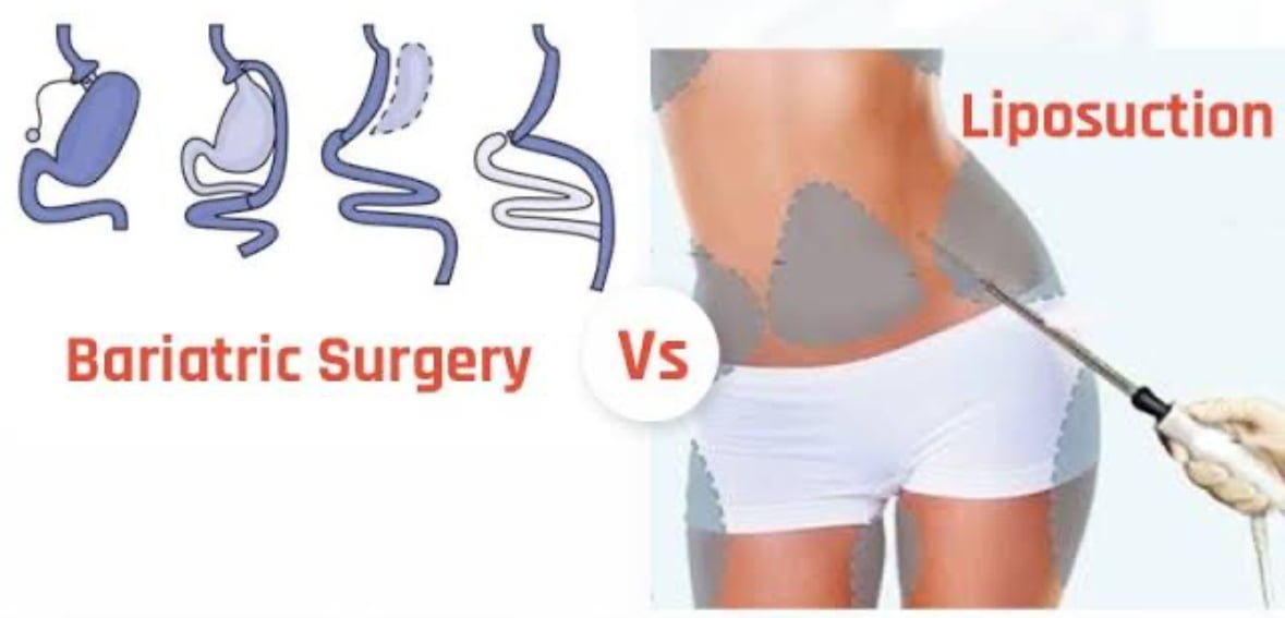 Sculpting Your Body Weight Loss Surgery vs. Liposuction Choosing the