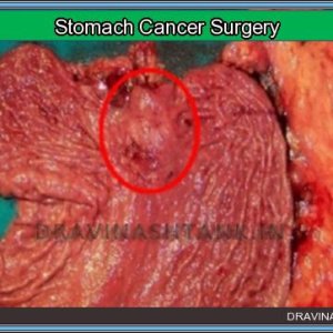cancer-surgery-20