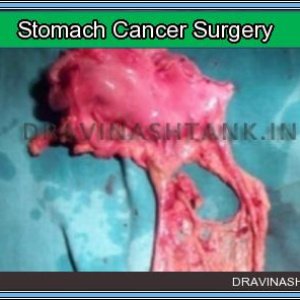 cancer-surgery-22